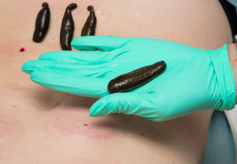 Leeches for boils – what are the benefits of applying leeches to boils?