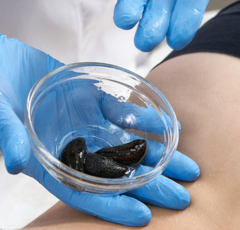 Leech therapy for haemorrhoids. How can leeches help with haemorrhoids