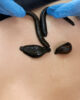 Leeches for sinus issues. How does leech therapy affect diseased sinuses?