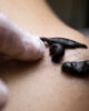 Sciatica and leech therapy. How sciatica manifests and how leeches can aid in its treatment?