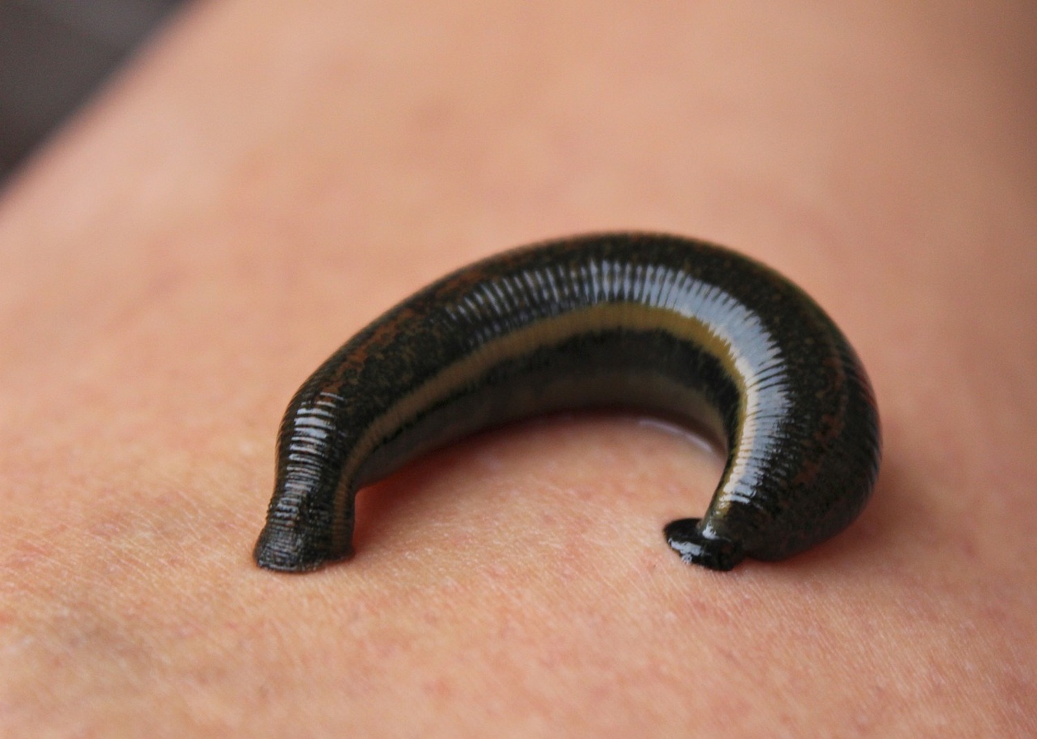 Leeches for skin fungus – can leeches cure fungal infections?