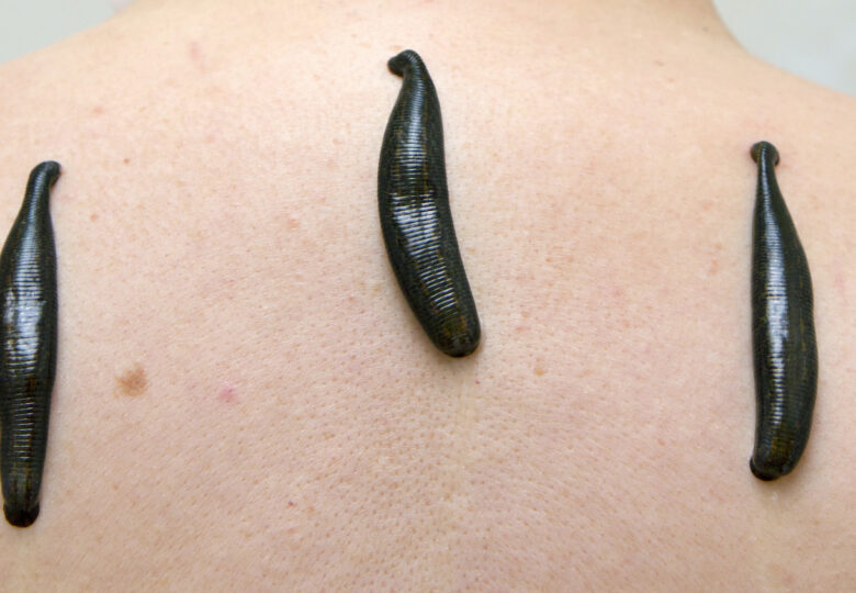 Leeches for atopic dermatitis – how can they help?