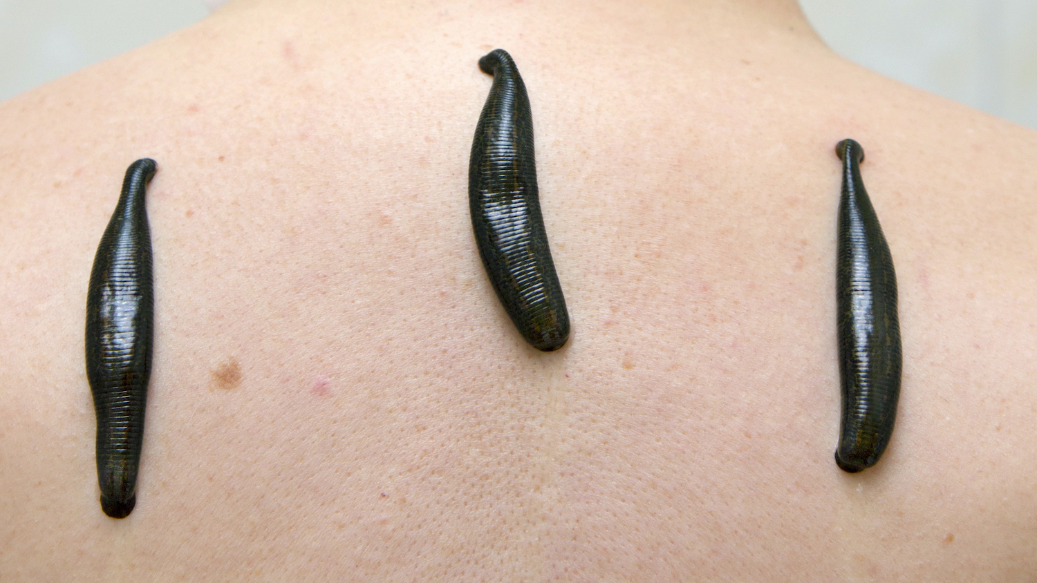 Leeches for atopic dermatitis – how can they help?