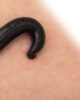 Do leeches support treatment for skin grafts?