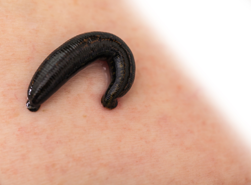 Do leeches support treatment for skin grafts?